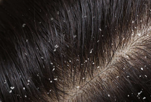 dandruff